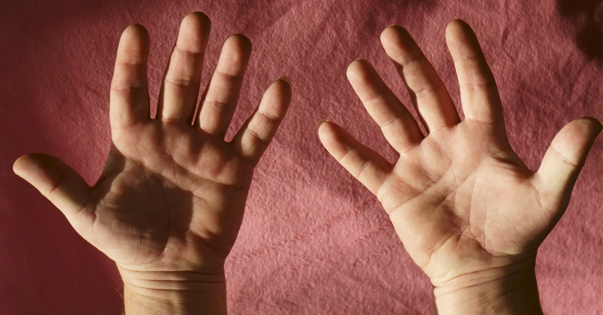acromegaly